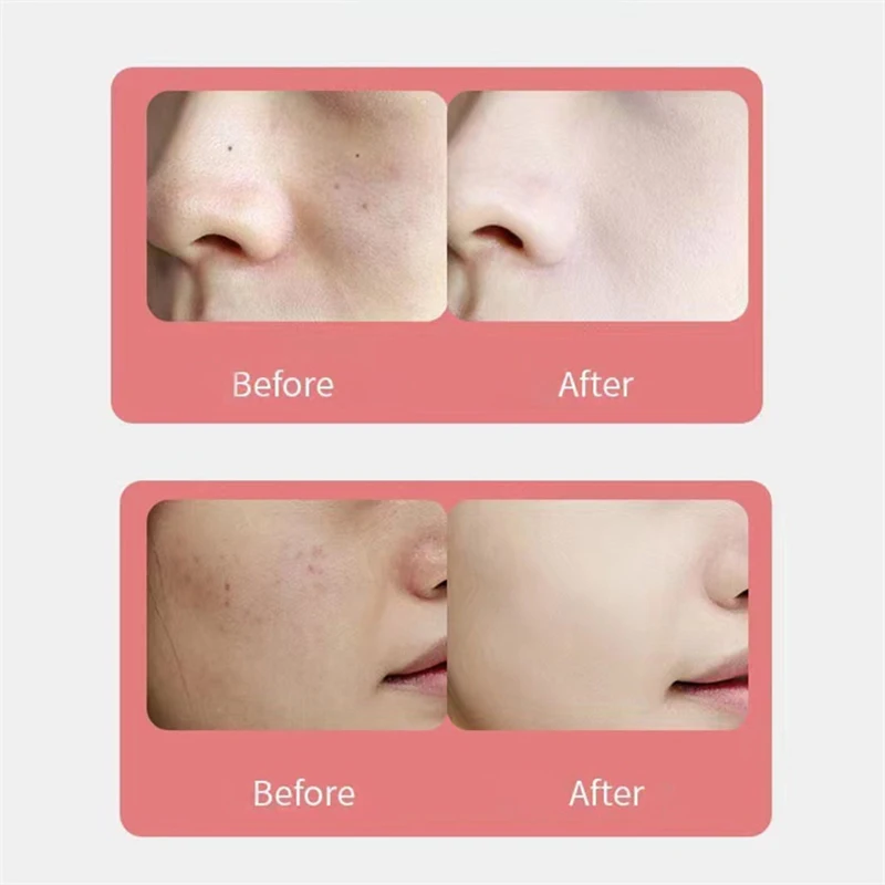 Electronic Remove Spot Beauty Equipment Blackhead Remover Dark Spot Pen Needle Scanning Mole Removal Device Skin Care Products