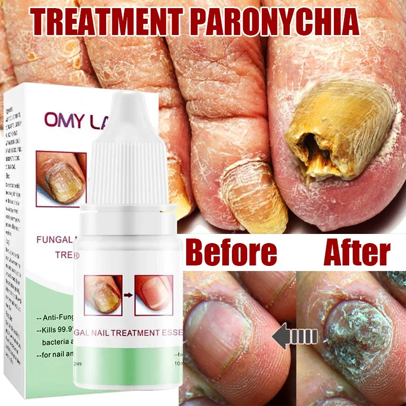 Fungal Nail Treatment Serum Foot Nail Fungus Removal Repair Gel Anti