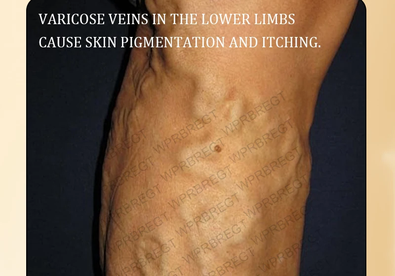 Pulse Massage Patch Eliminates Varicose Veins And Effectively Improves Blood Circulation_voghion.com