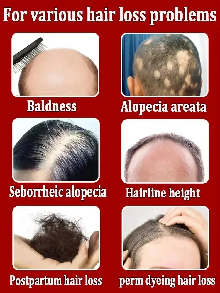 99% of buyers buy again, have more and more hair, say goodbye to baldness, thick hair,Hot selling product