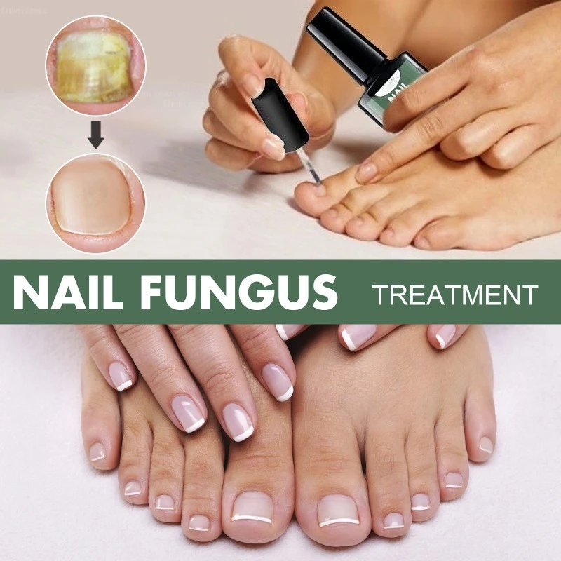 Nail Fungal Treatment Essence Oil Foot Toe Nail Fungus Removal Serum 7 Days Repair Onychomycosi Anti Infection Gel
