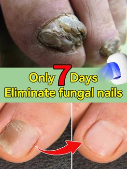 Laser Product Solves Nail troubles 1
