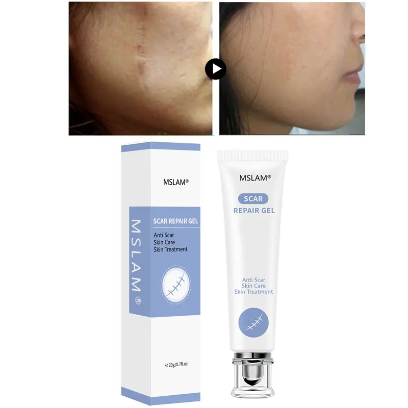 MSLAM Acne Scar Removal Cream Face Pimples Stretch Marks Gel Repairing