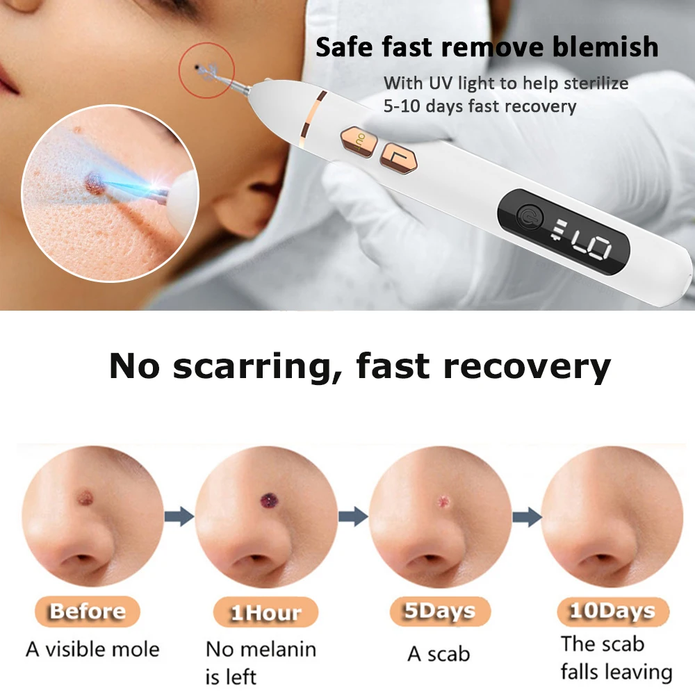 Laser Plasma Pen Skin Tag Remover