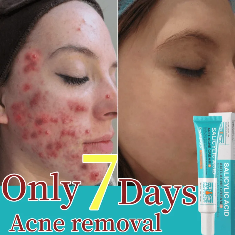 

New Salicylic Acid Acne Face Cream Effective Acne Scars Treatment Whiten Facial Shrink Pore Black Dots Remove Beauty Skin Care