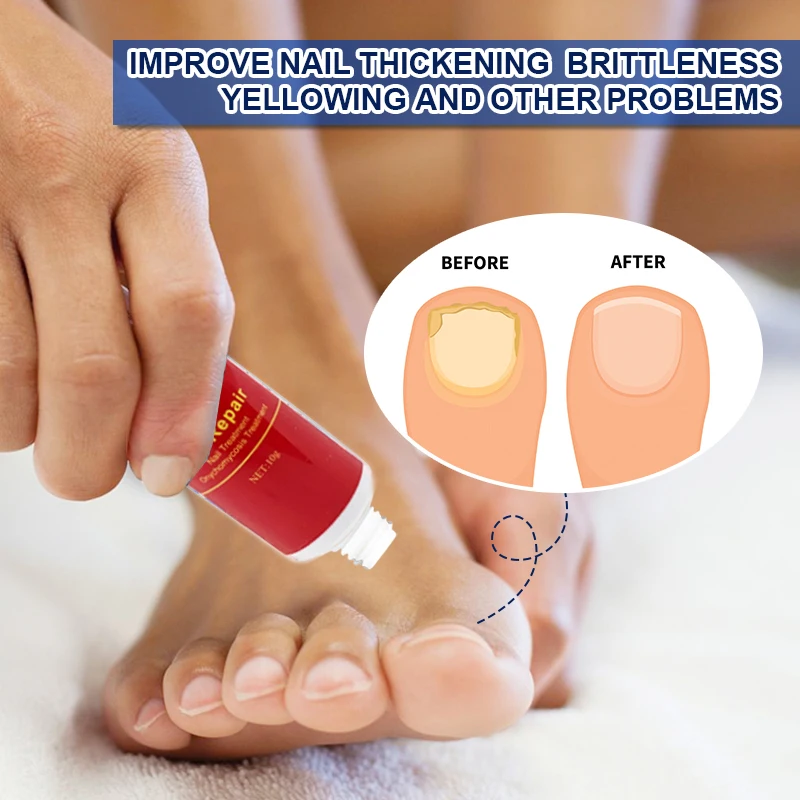 Treatment Fungal Nail Ointment Care Repair Foot Nail Fungus Removal Cream Anti Infection Paronychia Onychomycosis Product