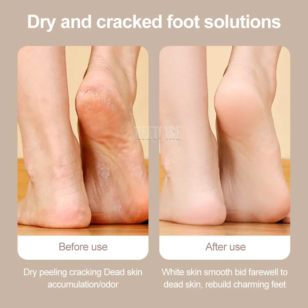 Mini Electric Pedicure Foot Grinder with LED Dry Peel USB Charging 3 Grinding Wheel Waterproof Foot Exfoliating Calluses Tool 6