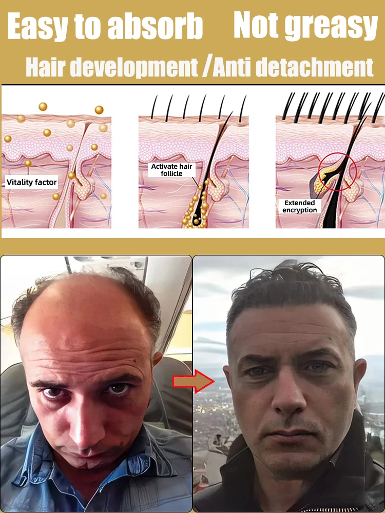 Fast Hair Growth Oil Natural Effective Anti Repair Baldness SeborrheicHereditary Postpartum Hairs Loss