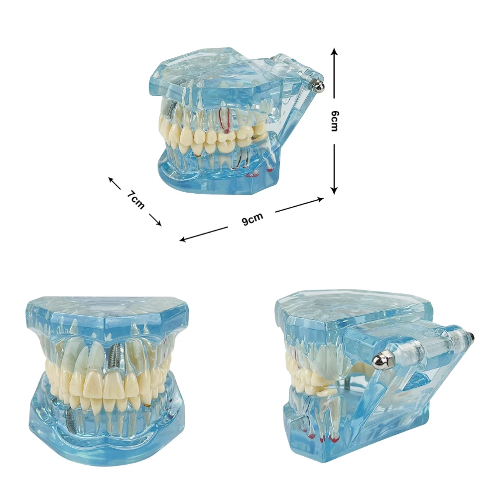 Dental Restoration & Disease Analysis Teaching Model