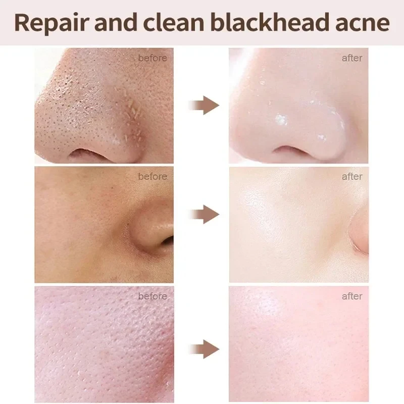 Salicylic Acid Pores Shrink Cream Refining Large Pore Improve Face Acnes Blackhead Remove Cream Anti-aging Oil Control Skin Care 3