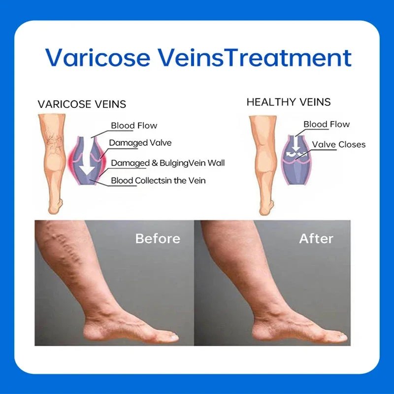 Effective Varicose Vein Treatments Cream Relieve Legs Dilated Vasculitis Phlebitis Natural Formula Body Creams images - 6