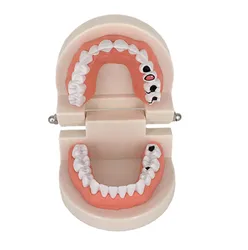 Dental Brushing Teeth Educational Model for Oral Hygiene and Teaching (With caries)