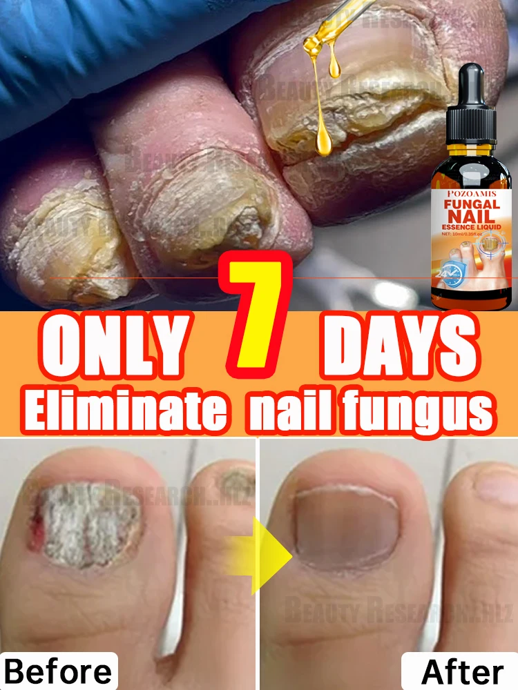 Treating fungal nails and onychomycosis