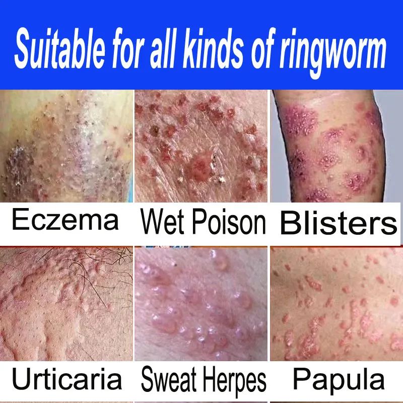 2PCSPsoriasisCreamItchReliefOintmentInhibitFungiTreatBodySkin