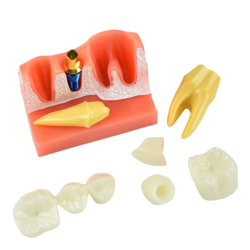 

Dental Endodontic Teeth Models Model 4 Times Implant Analysis Crown Bridge Demonstration Dentist Teaching Dentistry Clinic