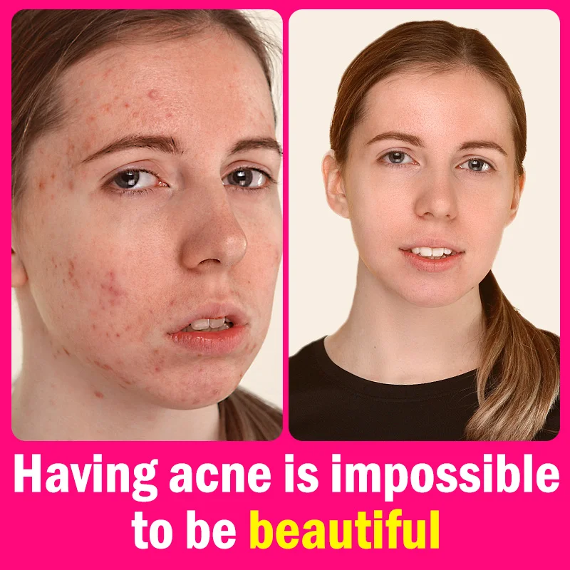 

Сыворотка с салициловой кислотой для очищения кожи, оригинальный увлажняющий отбеливающий уход за кожей