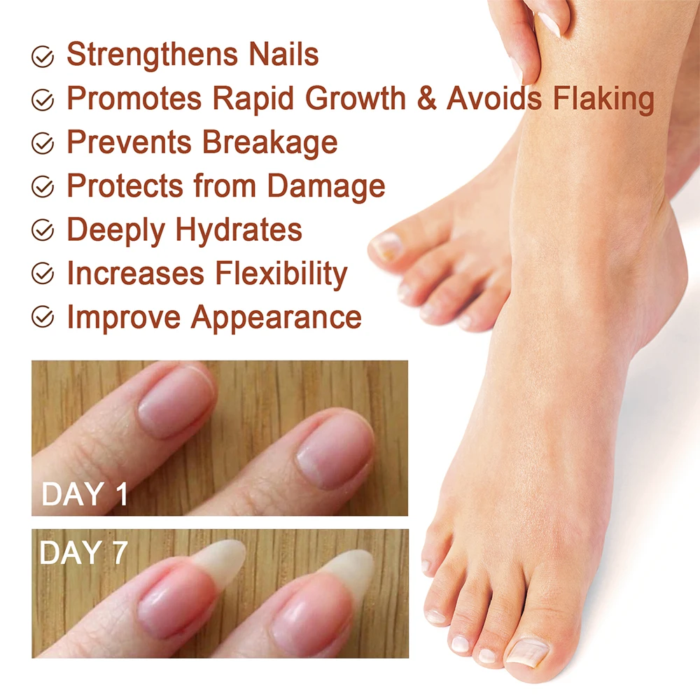 Nail Fungus Treatment Serum Toe Fungal Repair Products Hand Foot Care Removal Gel Anti Infection Onychomycosis Paronychia nail fungus remover