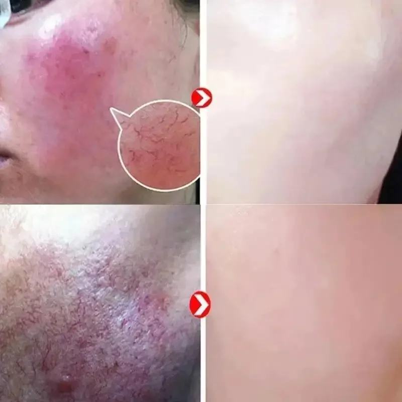 إصلاح احمرار الوجه كريم لحظة العنكبوت الوريد إزالة الجلد الحساسة تهدئة مكافحة احمرار Rosacea علاج غسول مستحضرات التجميل الكورية