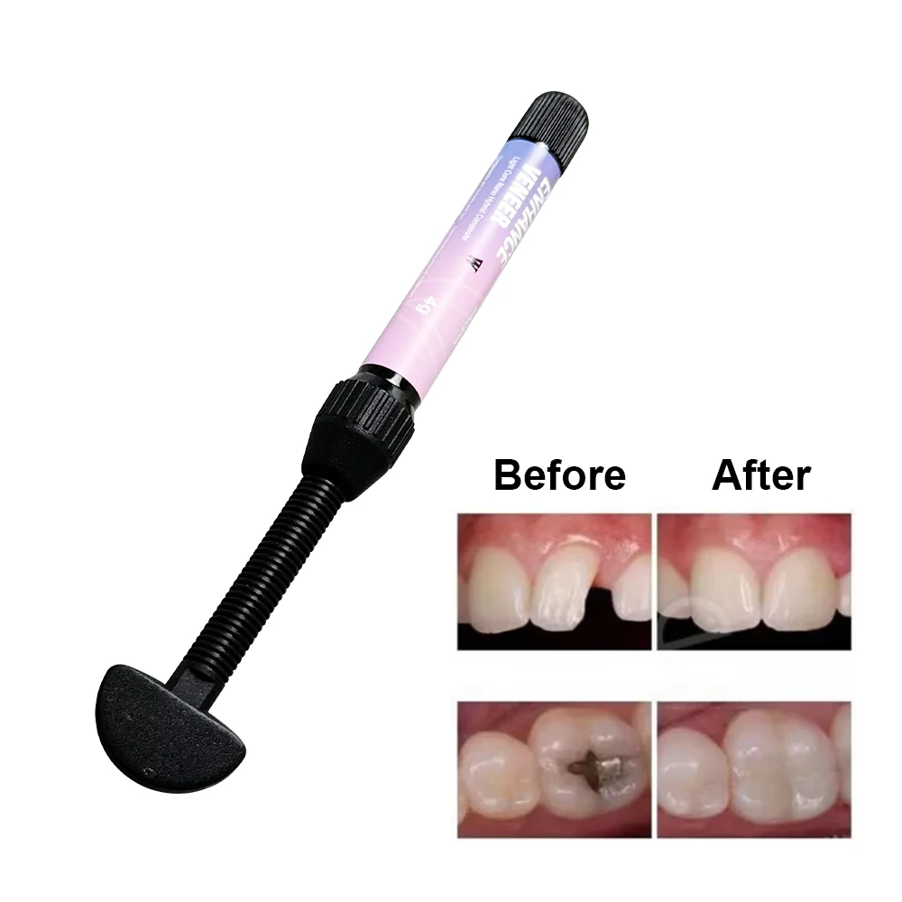 Materiale per Faccette Dentali 4g per Sbiancamento Denti, Resina Composita Fotopolimerizzabile Bianco Brillante, Materiali per Faccette in Ceramica Colore Bianco Perla - immagine 4