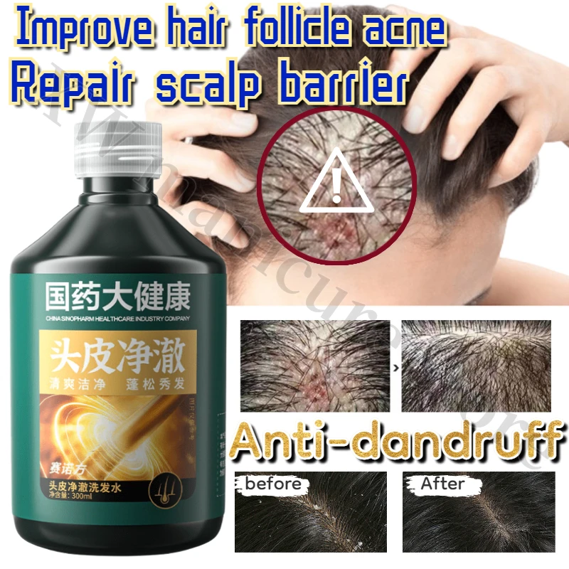 300ML Scalp Clarifying Shampoo Improve Hair Follicles Balance Water and Oil Anti-Dandruff  Anti-itch Refreshing Scalp Shampoo