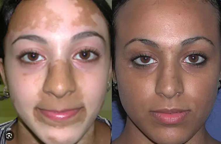 Super Effective Cream for Vitiligo White Spots Patches Re Pigmentation
