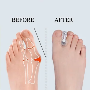 2pcs Bunion Hallux Valgus Corrector Toe Spreader Separator Thumb Finger Correction Straightener Foot Care Tool 2