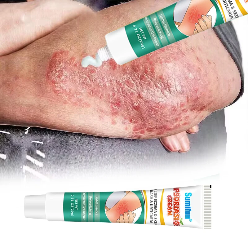 

Herbal Psoriasis Cream Treatment Dermatitis Eczematoid Pruritus Ointment Anti-Itching Antibacterial Health Skin Care Products