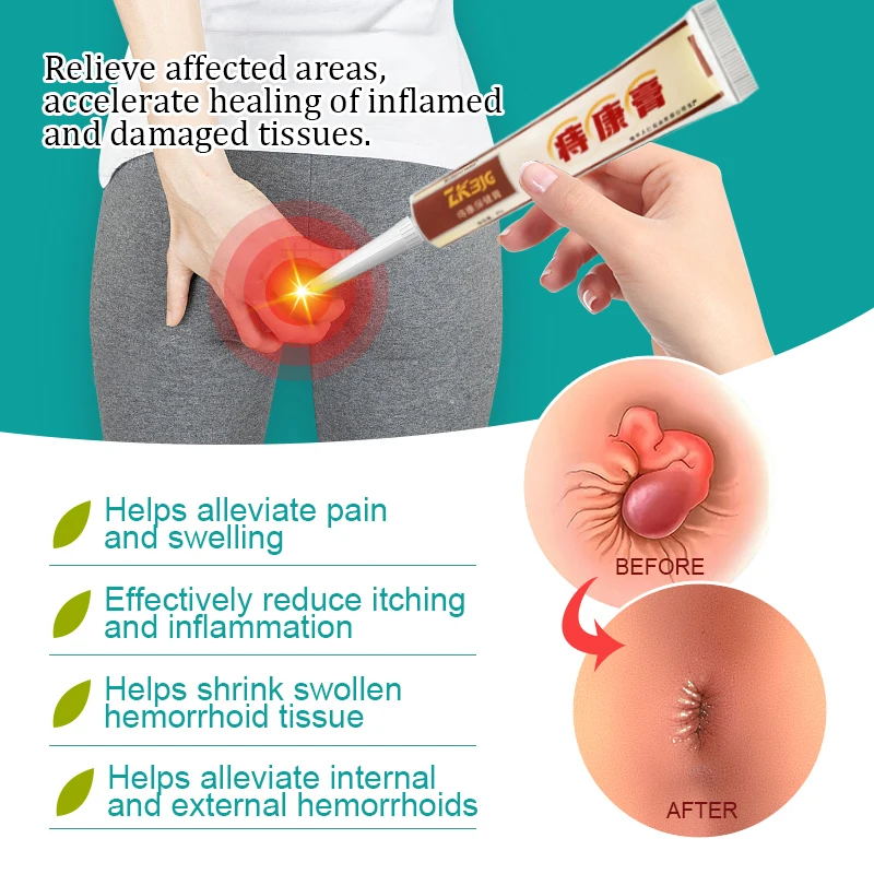 Hemorrhoids Treatment Cream Hua Tuo Hemorrhoid Cream Piles Elimination Pain Anal Bleeding Musk Herbal