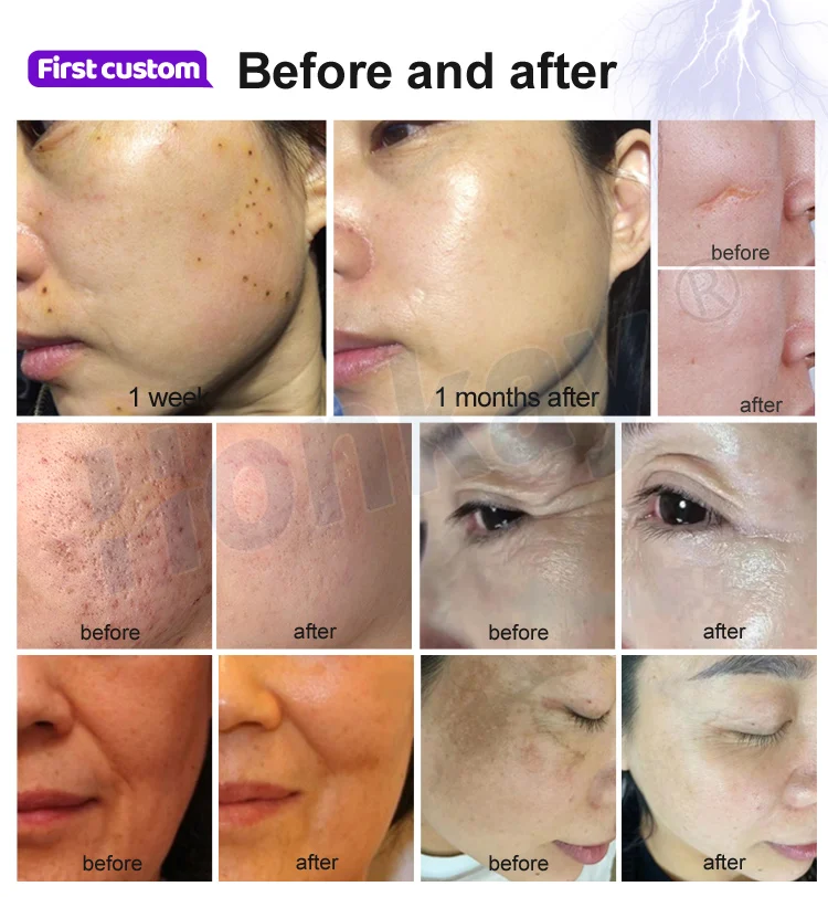 6 In 1 Professional Jet Plasma Lifting Skin Tightening Ozone Fibroblast Cold Plasma Pen Beauty Machine