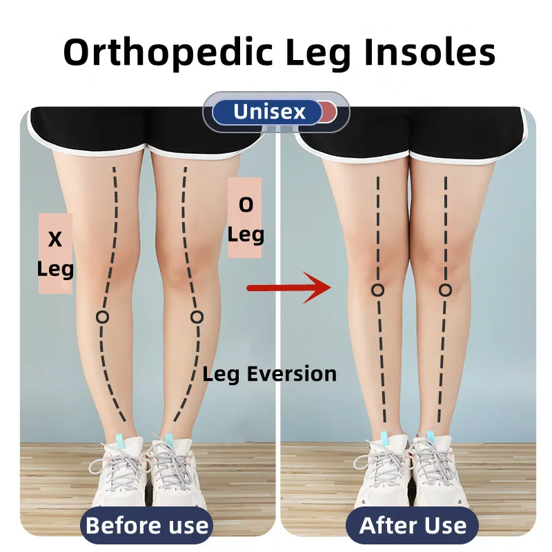 Silikon gel ortopedické insoles pro nohou magnetem masáž vložka O/X noha typ valgus varus korekce plantární fasciitis nohou péče