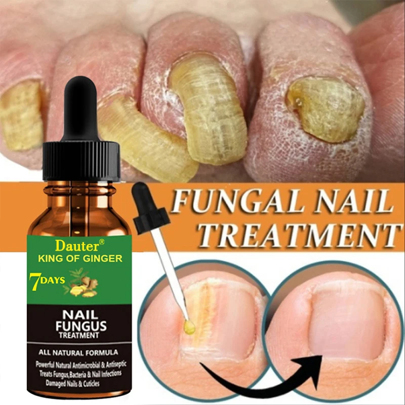 FootCareEssenceToenailFungusRemovalInfectiousParonychia