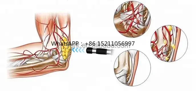 

Ударно-волновая терапевтическая машина по заводской цене для портативного домашнего использования