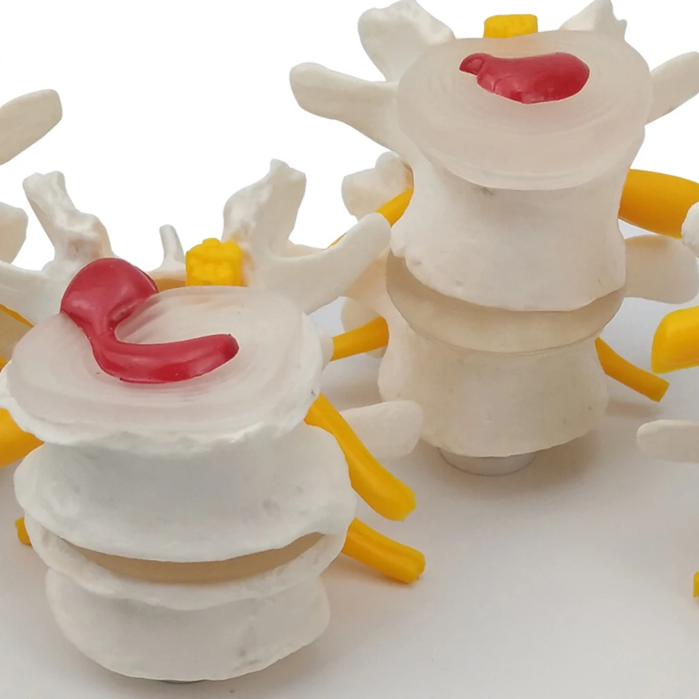 4-stage Pathological Human Lumbar Spine Anatomy Model Medical Science Teaching Resources Orthopedic Teaching Display Tools