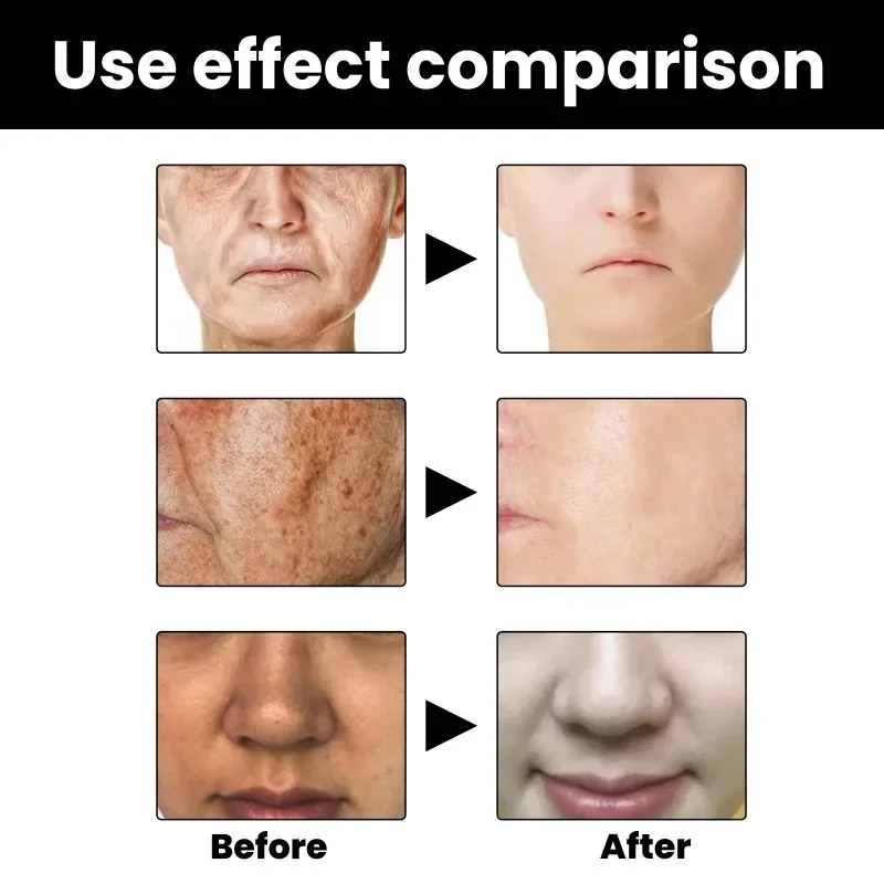 Whitening Freckle Serum Fade Melasma Dark Spots Remove Pigment Brighten Lighten Melanin Improve Dull Anti-aging Face Skin Care