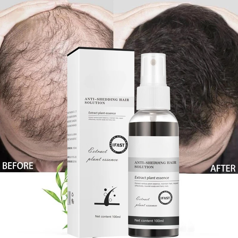 Herbal Formula Anti-Shedding Hair Solution Spray Antihair Loss Postpartum Hair Loss Hair Line Growth Solution Nourishes HairRoot