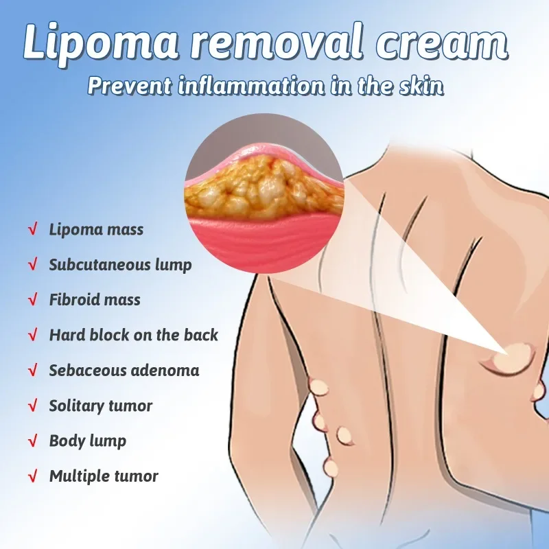 Lipoma Removal Medicines Spray Fibroma Cellulite Remover Apply To Subcutaneous Lumps Fat Mass Treatment Skin Swelling Cream cream lumps remover