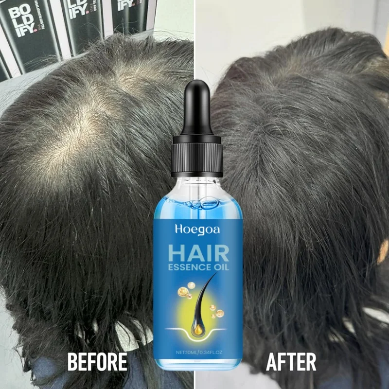 HOEGOA blue bottle.hair growth essential 0iI. Say goodbye to baIdness. The secret 0f thick hair hair growth serums