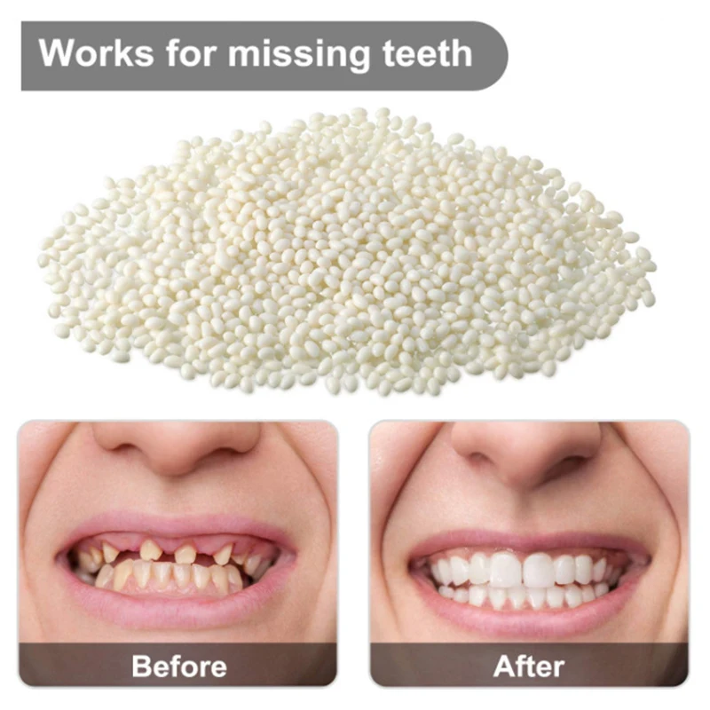 Pegamento para dentadura postiza temporal, pegamento sólido de 50G, cuentas  adhesivas moldeables, reparación de dientes de chapa, color blanco -  AliExpress