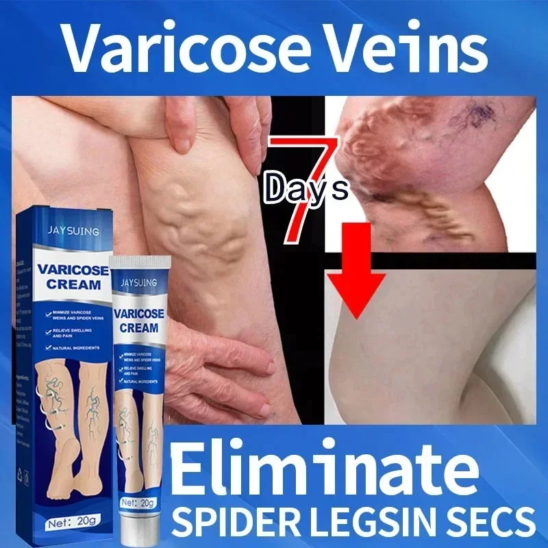 Ointment for Varicose Veins Eliminate Vasculitis Phlebitis to Relieve Spider Leg Pain Treatment Herbal cream 6