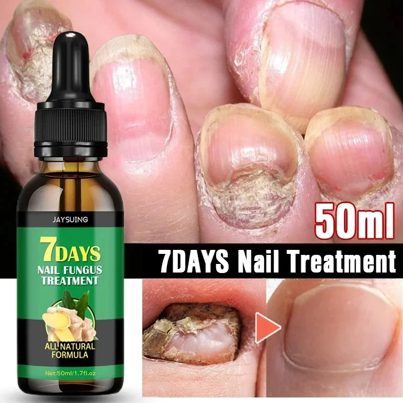 7 Day Nail Fungal Treatment Serum Foot Toe Nail Fungus Removal Essential Oil Anti Infection Onychomycosis Paronychia Repair Gel nail fungus remover