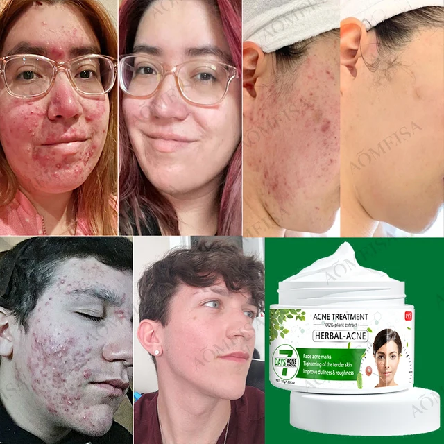 Pattanó Krém Gyógynövény-Esszencia Gyulladásgátló, Anti-Acne, Olajkontroll, Mindenféle Pattanáshoz Alkalmas - Image 2