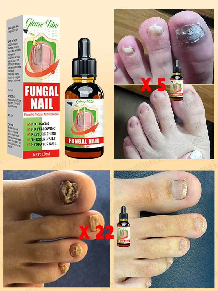Fungus solution nail fungus treatment essential oil repair onychomycosis in 7 days
