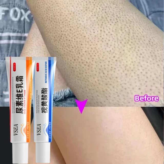Keratosis Pilaris Cream – Smooth, Clear & Soft Skin
