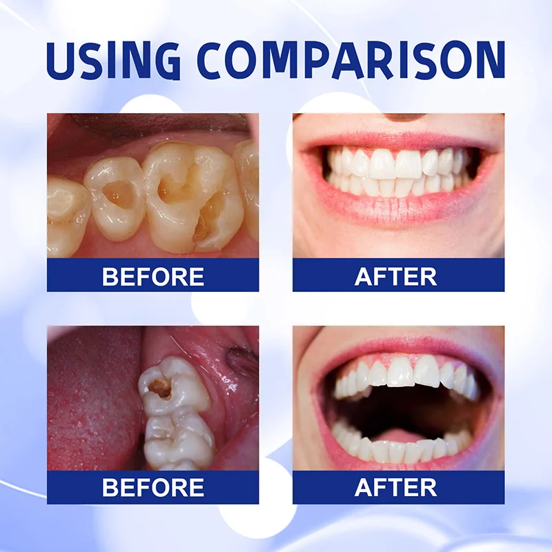 Riparazione della carie dentifricio sbiancante alito cattivo fresco carie Anti-cavità rimuovere la placca mal di denti alleviare la parodontite