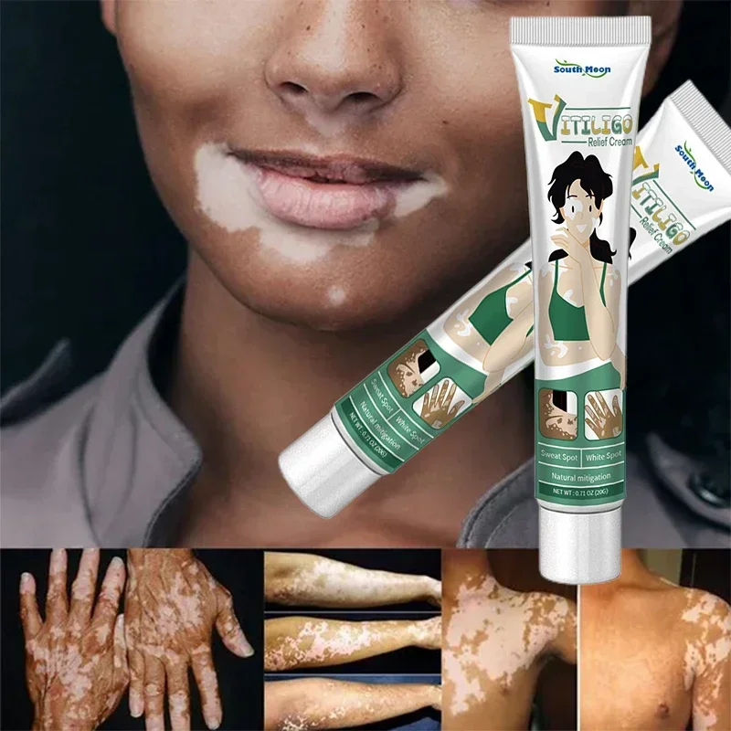 

Vitiligo Ointment Herbal Extract Remove Ringworm White Spot Removal Skin Vitiligo Eliminate Vitiligo Treatment Cream