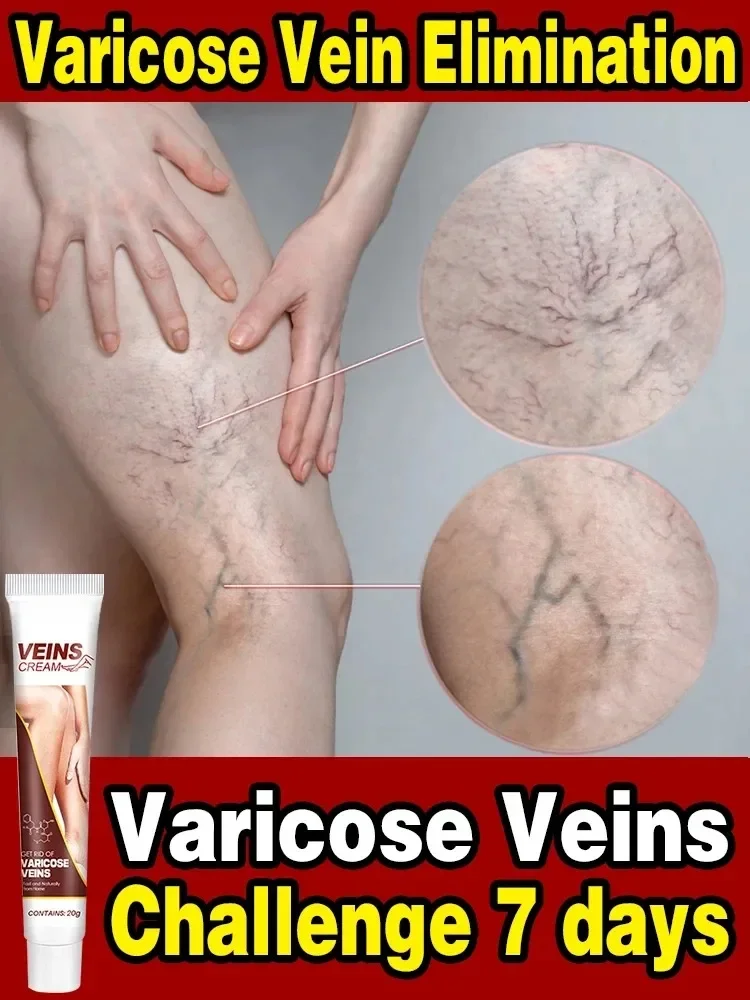 

Effective relief of varicose veins. Vasculitis, phlebitis, spider leg soothing