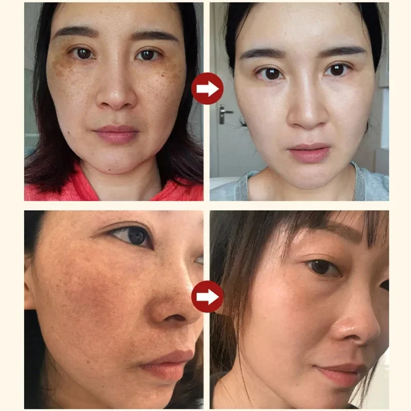 Powerful Spot-removing Whiten Facial Serum Niacinamide Salicylic Acid Moisturizing Korean Skin Care Products 2024 2