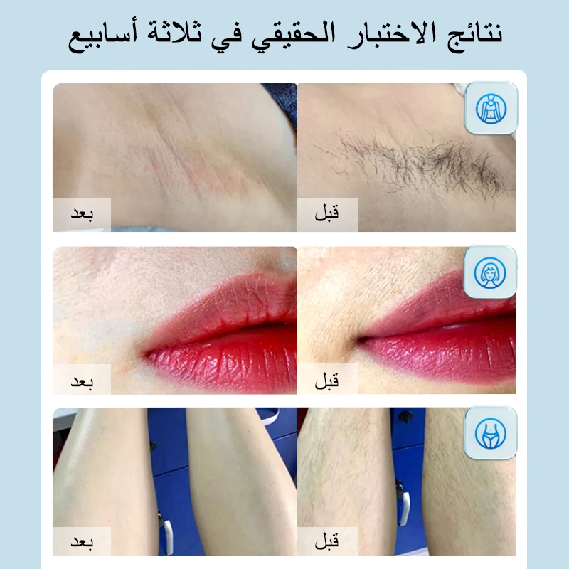 آلة لنزع الشعر بالليزر عدسة ل Mlay T14 آلة إزالة ا...