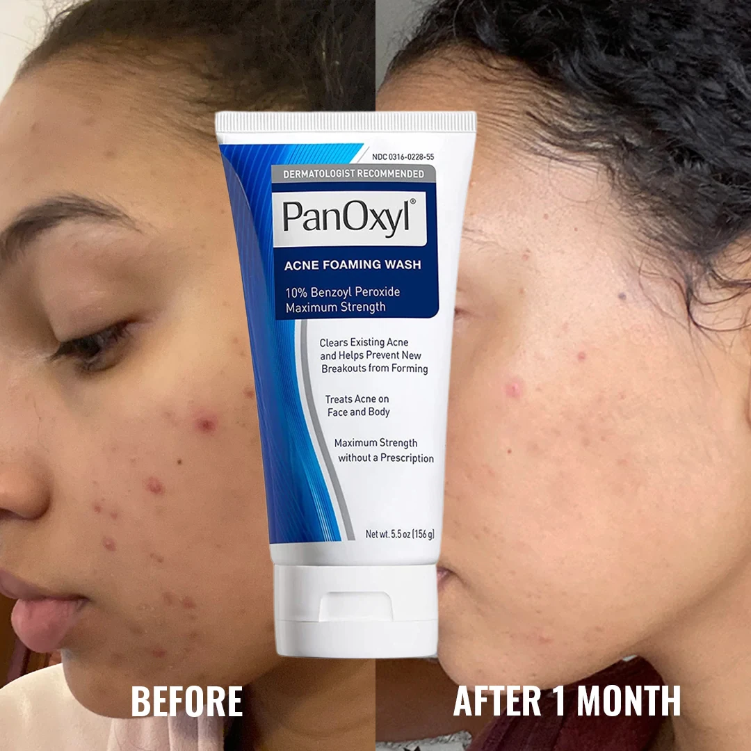 

NEW PanOxyl Anti-Acne Foaming Face Washer Oil Control Shrink Pores Facial Cleanser Gentle Deep Clean Moisturizing Skin Care