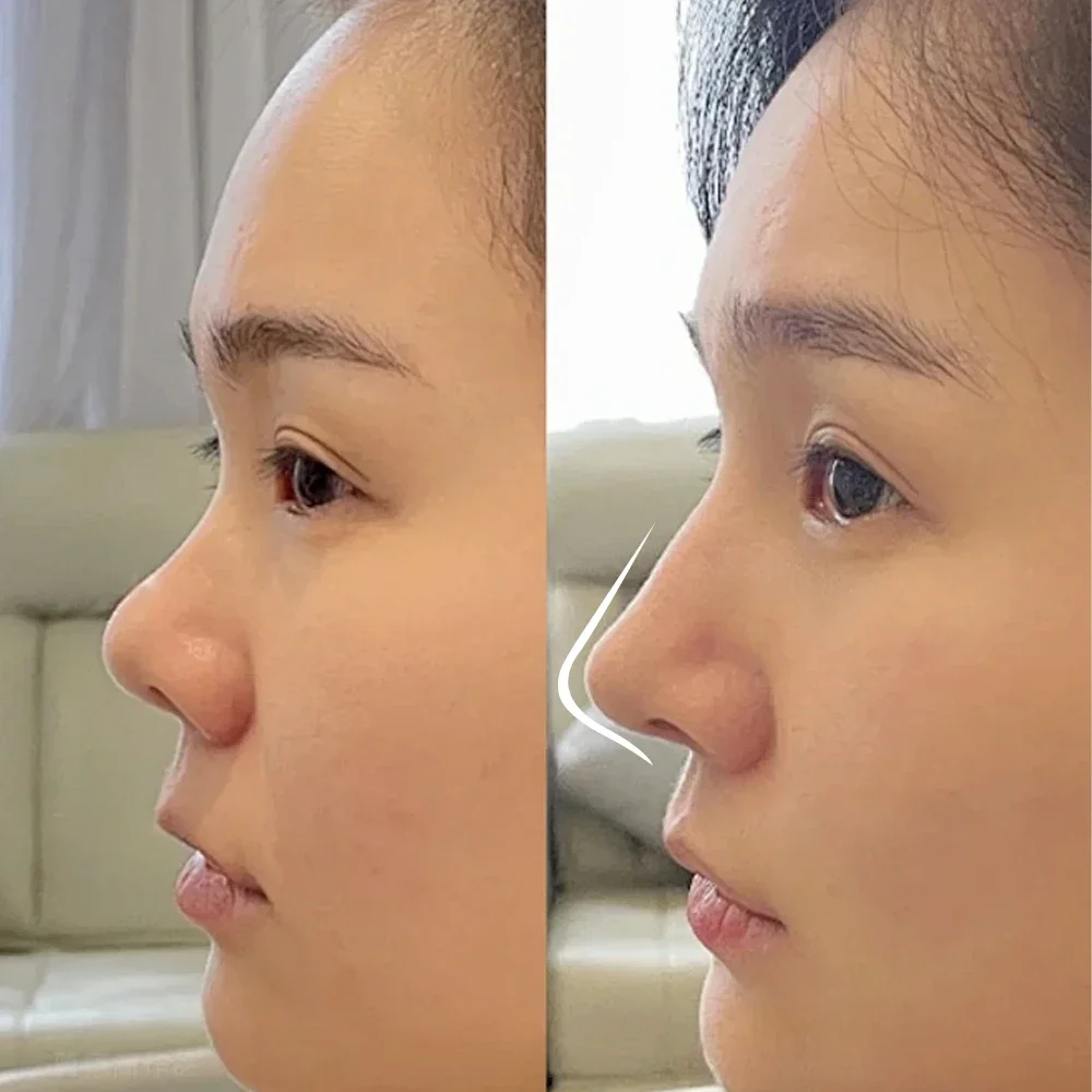 Thermoplastic Nasal Splint for Nose Fracture Correction and Support